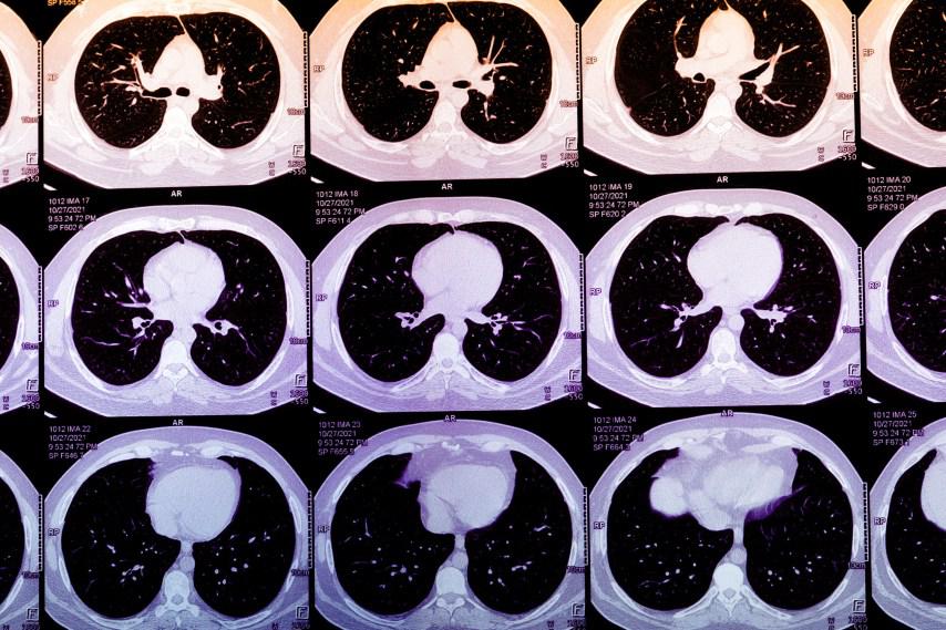 AI could predict who will have a heart attack