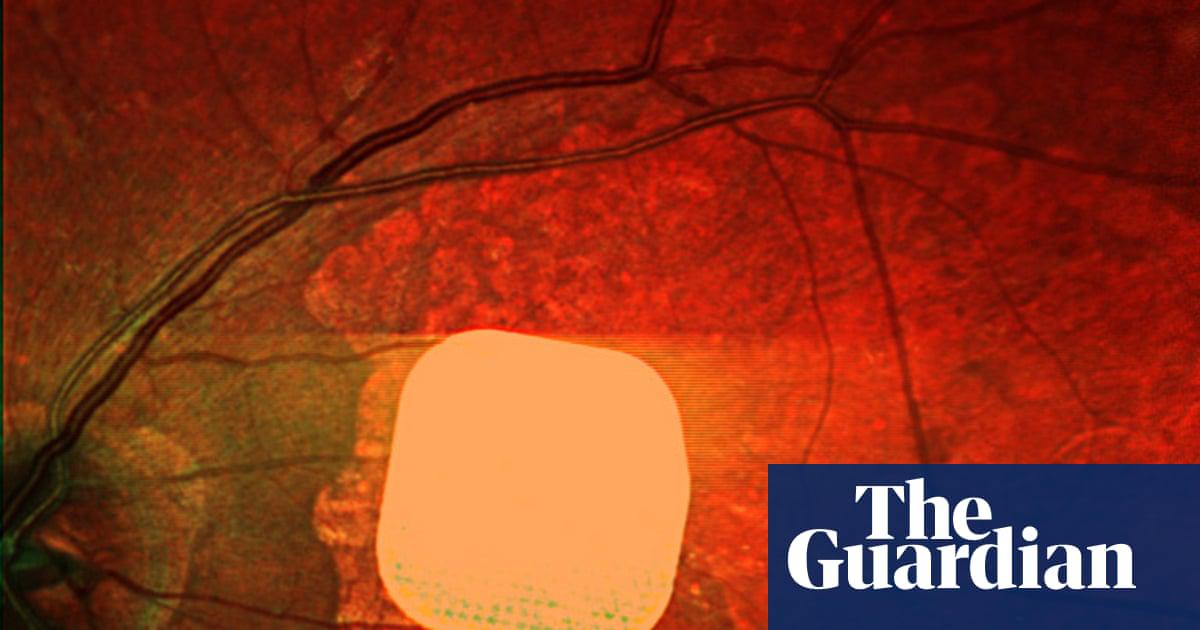 The new electronic eye implant that has enabled people who have lost their sight to geographic atrophy (as a result of dry AMD) to read again.