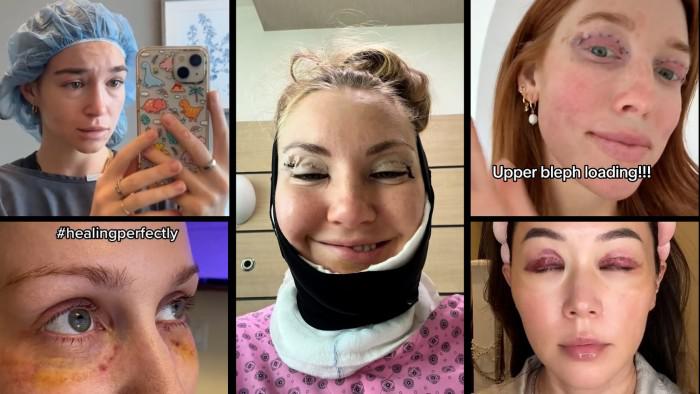 The blepharoplasty boom 